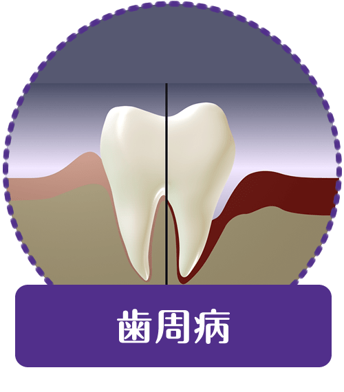 歯周病｜【宝塚市の歯医者】歯科・小児歯科・こどもの小児矯正はとがわ歯科クリニック│売布・ダイエー宝塚中山店