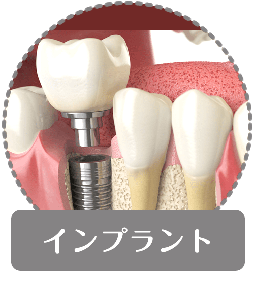 インプラント｜【宝塚市の歯医者】歯科・小児歯科・こどもの小児矯正はとがわ歯科クリニック│売布・ダイエー宝塚中山店