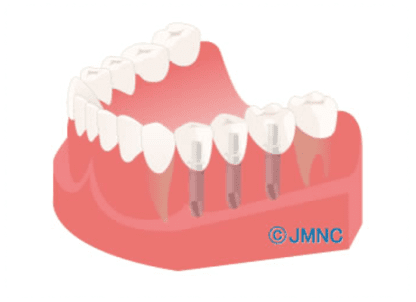 インプラント｜【宝塚市の歯医者】歯科・小児歯科・こどもの小児矯正はとがわ歯科クリニック│売布・ダイエー宝塚中山店